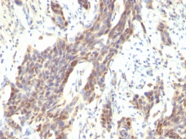 Formalin-fixed, paraffin-embedded human Bladder Carcinoma stained with Cyclin D1 Mouse Monoclonal Antibody (CCND1/809).