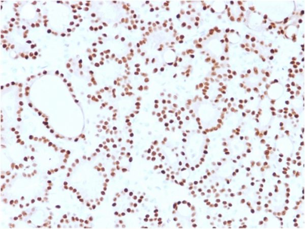 Formalin-fixed, paraffin-embedded human thyroid carcinoma stained with Cyclin D1 Mouse Monoclonal Antibody (CCND1/2593).