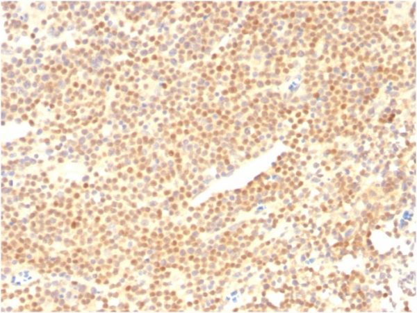 Formalin-fixed, paraffin-embedded human Mantle Cell Lymphoma stained with Cyclin D1 Mouse Monoclonal Antibody (CCND1/2593).