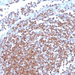 Formalin-fixed, paraffin-embedded human mantle cell lymphoma stained Cyclin D1 Recombinant Rabbit Monoclonal Antibody (CCND1/3370R).