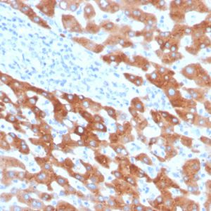 Formalin-fixed, paraffin-embedded human liver carcinoma in colon stained with RBP4 Mouse Monoclonal Antibody (RBP4/4041).