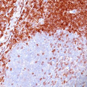 Formalin-fixed, paraffin-embedded human non-Hodgkin&apos;s lymphoma stained with Bcl-2 Mouse Monoclonal Antibody (100/D5).