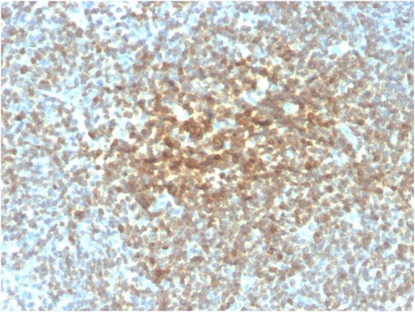 Formalin-fixed, paraffin-embedded human follicular lymphoma stained with Bcl-2 Recombinant Mouse Monoclonal Antibody (rBCL2/782).