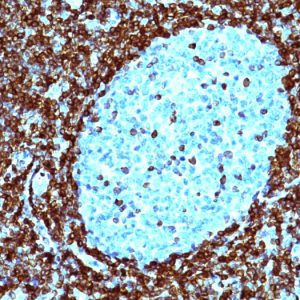 Formalin-fixed, paraffin-embedded human non-Hodgkin&apos;s lymphoma stained with Bcl-2 Mouse Monoclonal Antibody (124).