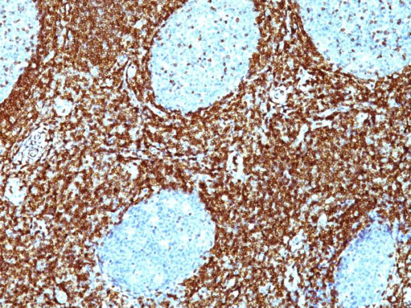 Formalin-fixed, paraffin-embedded human non-Hodgkin&apos;s lymphoma stained with Bcl-2 Monoclonal Antibody (BCL2/782 + BCL2/796).