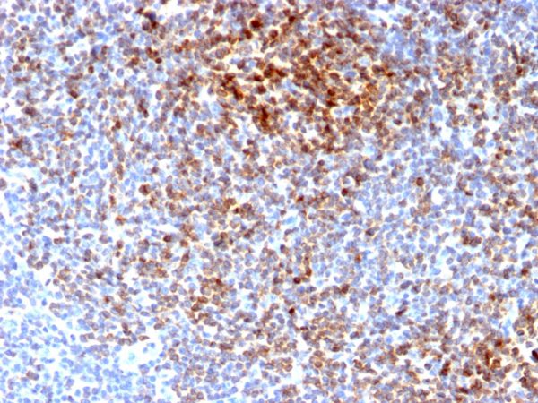Formalin-fixed, paraffin-embedded human Follicular Lymphoma stained with Bcl-2 Rabbit Recombinant Monoclonal Antibody (BCL2/2210R).