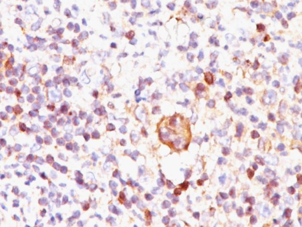 Formalin-fixed, paraffin-embedded Hodgkin&apos;s lymphoma stained with Bcl-x Mouse Monoclonal Antibody (BX006).