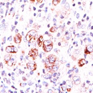 Formalin-fixed, paraffin-embedded Hodgkin&apos;s lymphoma stained with Bcl-x Mouse Monoclonal Antibody (2H12).