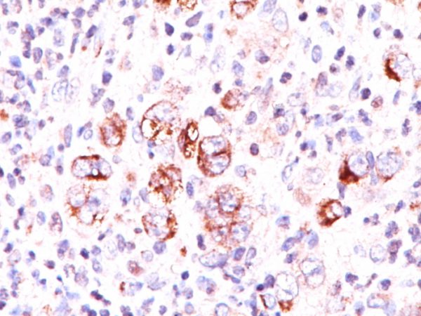 Formalin-fixed, paraffin-embedded Hodgkin&apos;s lymphoma stained with Bcl-x Mouse Monoclonal Antibody (2H12).