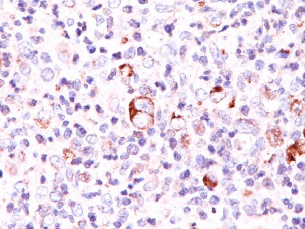 Formalin-fixed, paraffin-embedded Hodgkin&apos;s lymphoma stained with Bcl-x Mouse Monoclonal Antibody (SPM165).