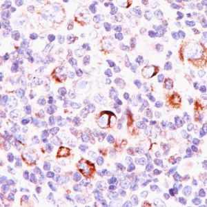 Formalin-fixed, paraffin-embedded Hodgkin&apos;s lymphoma stained with Bcl-x Mouse Monoclonal Antibody (SPM337).