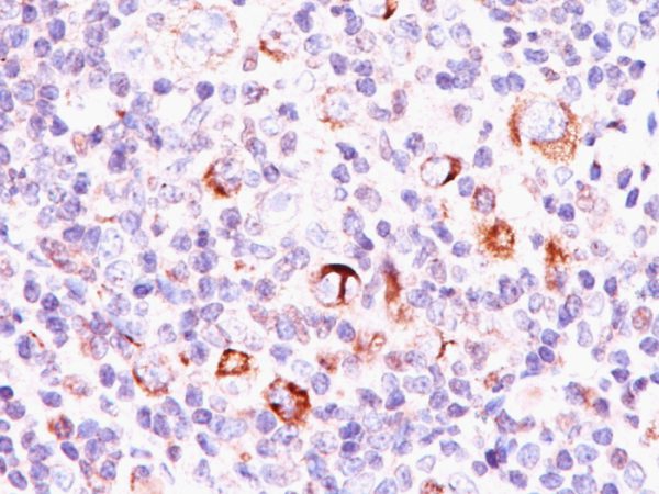 Formalin-fixed, paraffin-embedded Hodgkin&apos;s lymphoma stained with Bcl-x Mouse Monoclonal Antibody (SPM337).