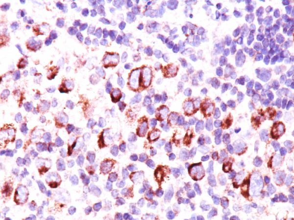 Formalin-fixed, paraffin-embedded Hodgkin&apos;s lymphoma stained with Bcl-x Monoclonal Antibody (BX006 + 2H12).