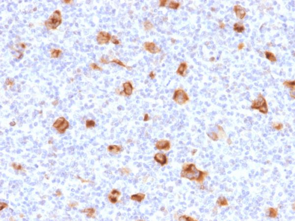 Formalin-fixed, paraffin-embedded Hodgkin&apos;s lymphoma stained with Bcl-x Mouse Monoclonal Antibody (SPM519).