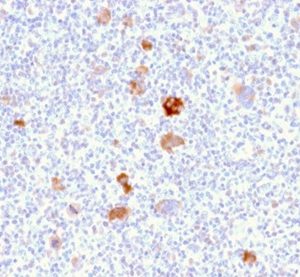 Formalin-fixed, paraffin-embedded Hodgkin&apos;s lymphoma stained with Bcl-x Mouse Monoclonal Antibody (BCL2L1/2406) at 2ug/ml. HIER: Tris/EDTA, pH9.0, 45min. 2 °: HRP-polymer, 30min. DAB, 5min.