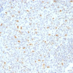 Formalin-fixed, paraffin-embedded human Hodgkin&apos;s Lymphoma stained with BCL-6 Mouse Monoclonal Antibody (BCL6/1526).