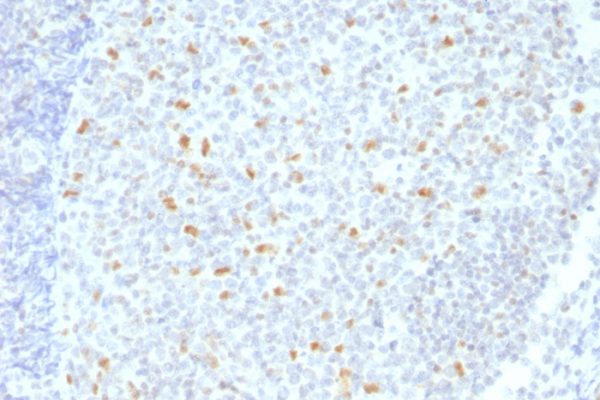 Formalin-fixed, paraffin-embedded human Hodgkin&apos;s Lymphoma stained with BCL-6 Mouse Monoclonal Antibody (BCL6/1526).