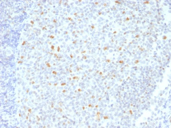 Formalin-fixed, paraffin-embedded human Hodgkin&apos;s Lymphoma stained with BCL-6 Mouse Monoclonal Antibody (BCL6/1526).