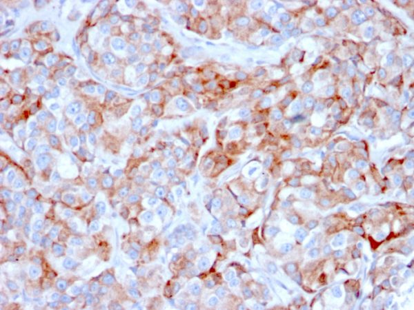 Formalin-fixed, paraffin-embedded human gastric carcinoma stained with CD269 / TNFRSF17 Mouse Monoclonal Antibody (BCMA/2366).