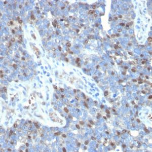 Formalin-fixed, paraffin-embedded human colon carcinoma stained with ROR-gamma / RORC Mouse Monoclonal Antibody (RORC/2941).