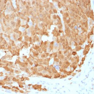 Formalin-fixed, paraffin-embedded human Melanoma stained with S100A1 Mouse Monoclonal Antibody (S100A1/1942).