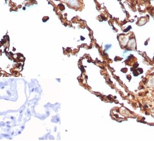 Formalin-fixed, paraffin-embedded human lung stained with S100A4 Mouse Monoclonal Antibody (S100A4/6803). HIER: Tris/EDTA, pH9.0, 45min. 2 °: HRP-polymer, 30min. DAB, 5min.
