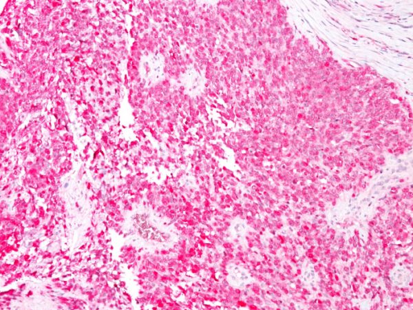 Formalin-fixed, paraffin-embedded human Melanoma stained with S100B Mouse Monoclonal Antibody (4C4.9) (AEC Chromogen)