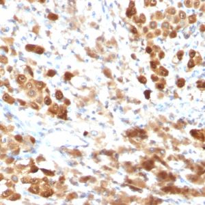 Formalin-fixed, paraffin-embedded human Melanoma stained with S100B Mouse Monoclonal Antibody (SPM354).