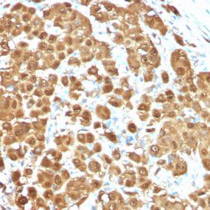Formalin-fixed, paraffin-embedded human Melanoma stained with S100B Mouse Monoclonal Antibody (S100B/1012).