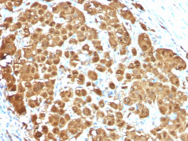 Formalin-fixed, paraffin-embedded human Melanoma stained with S100B Mouse Monoclonal Antibody (S100B/1012).
