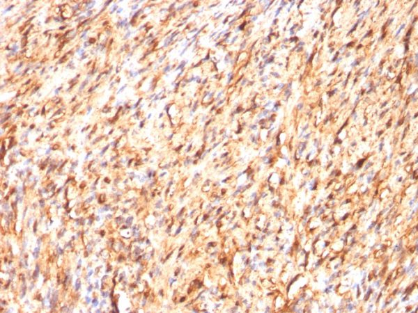 Formalin-fixed, paraffin-embedded human Schwanoma stained with S100B Mouse Monoclonal Antibody (S100B/1012).