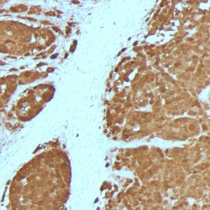 Formalin-fixed, paraffin-embedded human Melanoma stained with S100B Mouse Monoclonal Antibody (4C4.9 + S100B/1012)