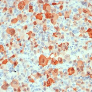 Formalin-fixed, paraffin-embedded human melanoma stained with S100B Mouse Recombinant Monoclonal Antibody (rS100B/1896).