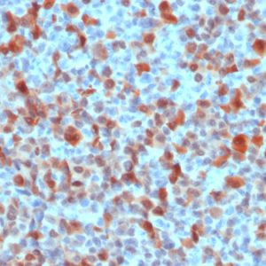 Formalin-fixed, paraffin-embedded human Melanoma stained with S100B Rabbit Polyclonal Antibody.