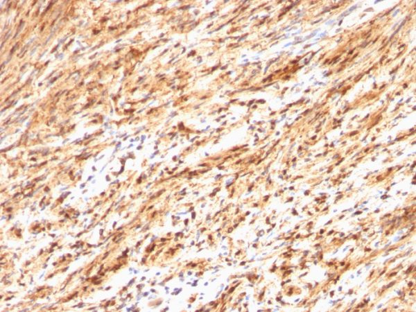 Formalin-fixed, paraffin-embedded human Schwanoma stained with S100B Rabbit Polyclonal Antibody.