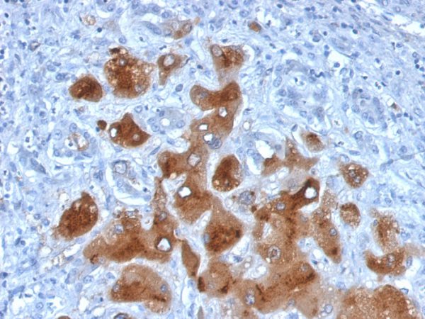 Formalin-fixed, paraffin-embedded human Hepatocellular Carcinoma stained with Serum Amyloid A Mouse Monoclonal Antibody (SAA/326).