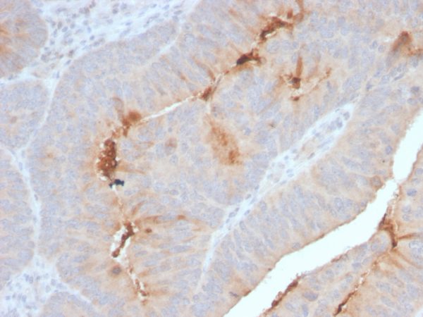 Formalin-fixed, paraffin-embedded human Colon Carcinoma stained with Serum Amyloid A Recombinant Rabbit Monoclonal Antibody (SAA/2868R).