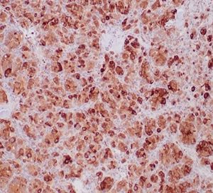 Formalin-fixed, paraffin-embedded human paraganglioma stained with SDHB Recombinant Rabbit Monoclonal Antibody (SDHB/6697R).