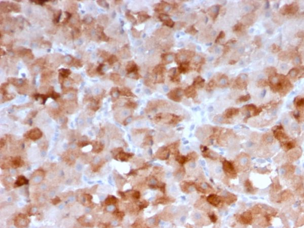 Formalin-fixed, paraffin-embedded human SqCC stained with VISTA Monospecific Mouse Monoclonal Antibody (VISTA/3007).