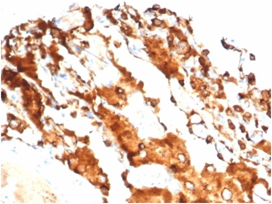 Formalin-fixed, paraffin-embedded human lung carcinoma stained with Surfactant Protein DRecombinant Rabbit Monoclonal (SFTPD/7084R).
