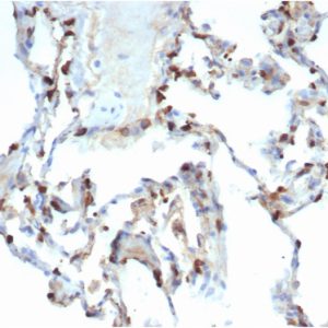 Formalin-fixed, paraffin-embedded human lung carcinoma stained with Surfactant Protein D Recombinant Rabbit Monoclonal (SFTPD/7086R).