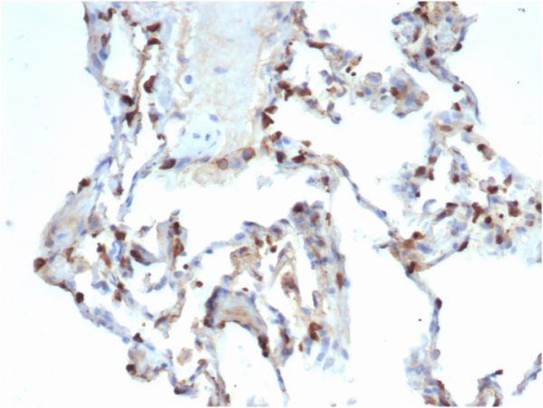 Formalin-fixed, paraffin-embedded human lung carcinomastained with Surfactant Protein DRecombinant Rabbit Monoclonal (SFTPD/7086R).