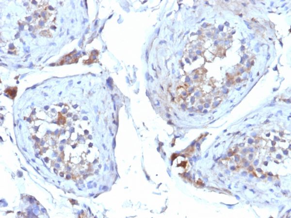 Formalin-fixed, paraffin-embedded human Testicular Carcinoma stained with SHBG Mouse Monoclonal Antibody (SHBG/245).