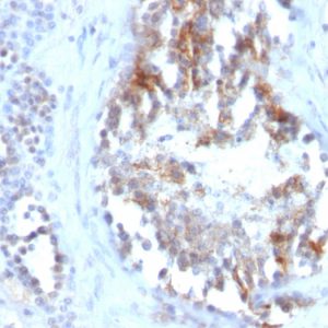 Formalin-fixed, paraffin-embedded human Testicular Carcinoma stained with SHBG Monoclonal Antibody (SPM605)