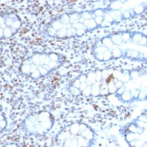 Formalin-fixed, paraffin-embedded human Colon Carcinoma stained with BMI1-Monospecific Mouse Monoclonal Antibody (BMI1/2689).