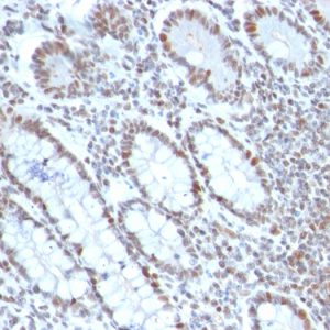 Formalin-fixed, paraffin-embedded human Colon Carcinoma stained with BMI1 Mouse Monoclonal Antibody (BMI1/2690).