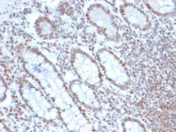Formalin-fixed, paraffin-embedded human Colon Carcinoma stained with BMI1 Mouse Monoclonal Antibody (BMI1/2690).