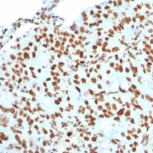 Formalin-fixed, paraffin-embedded human Breast Carcinoma stained with BMI1 Mouse Monoclonal Antibody (BMI1/2823).