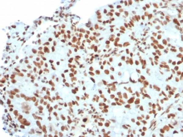 Formalin-fixed, paraffin-embedded human Breast Carcinoma stained with BMI1 Mouse Monoclonal Antibody (BMI1/2823).