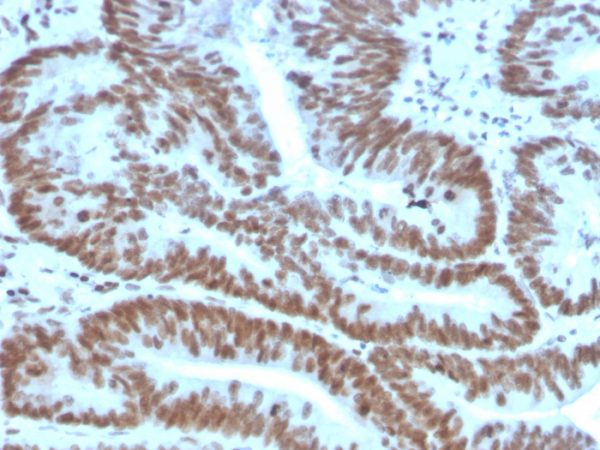 Formalin-fixed, paraffin-embedded human Colon Carcinoma stained with BMI1 Mouse Monoclonal Antibody (BMI1/2823).
